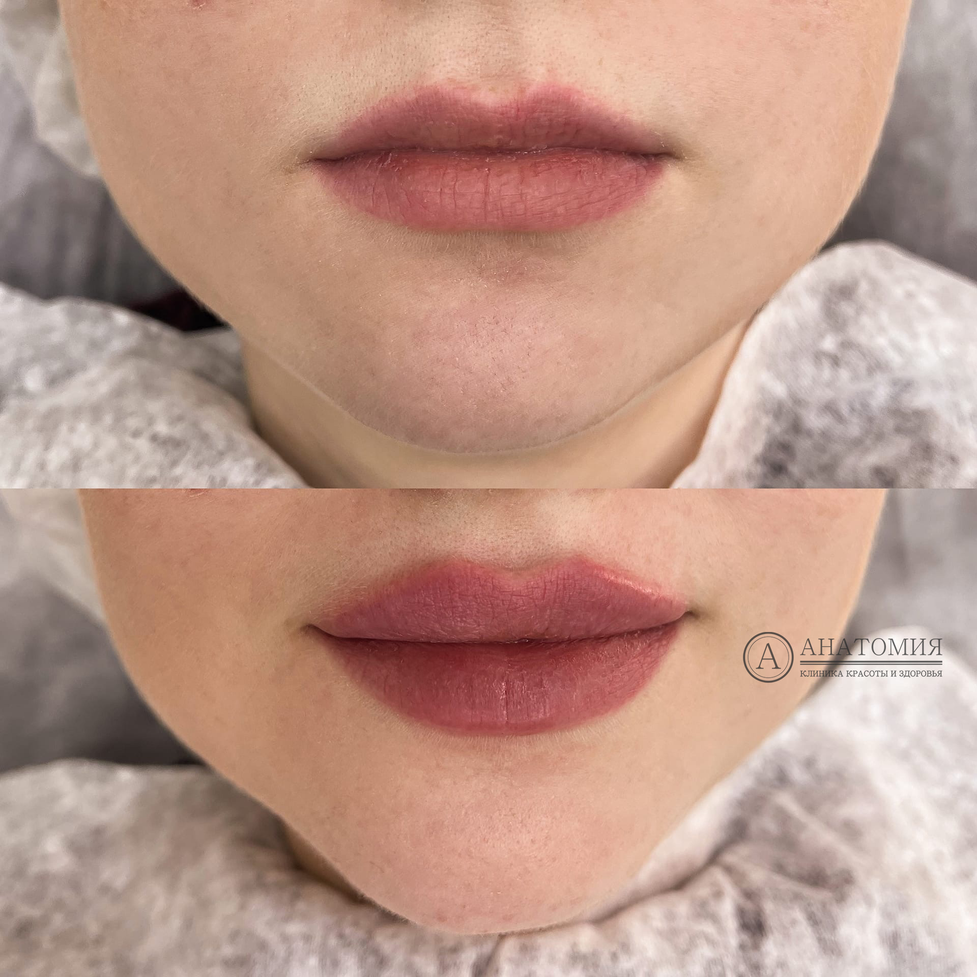 Примеры до и после контурной пластики губ (аугментация губ) | Сеть клиник Анатомия