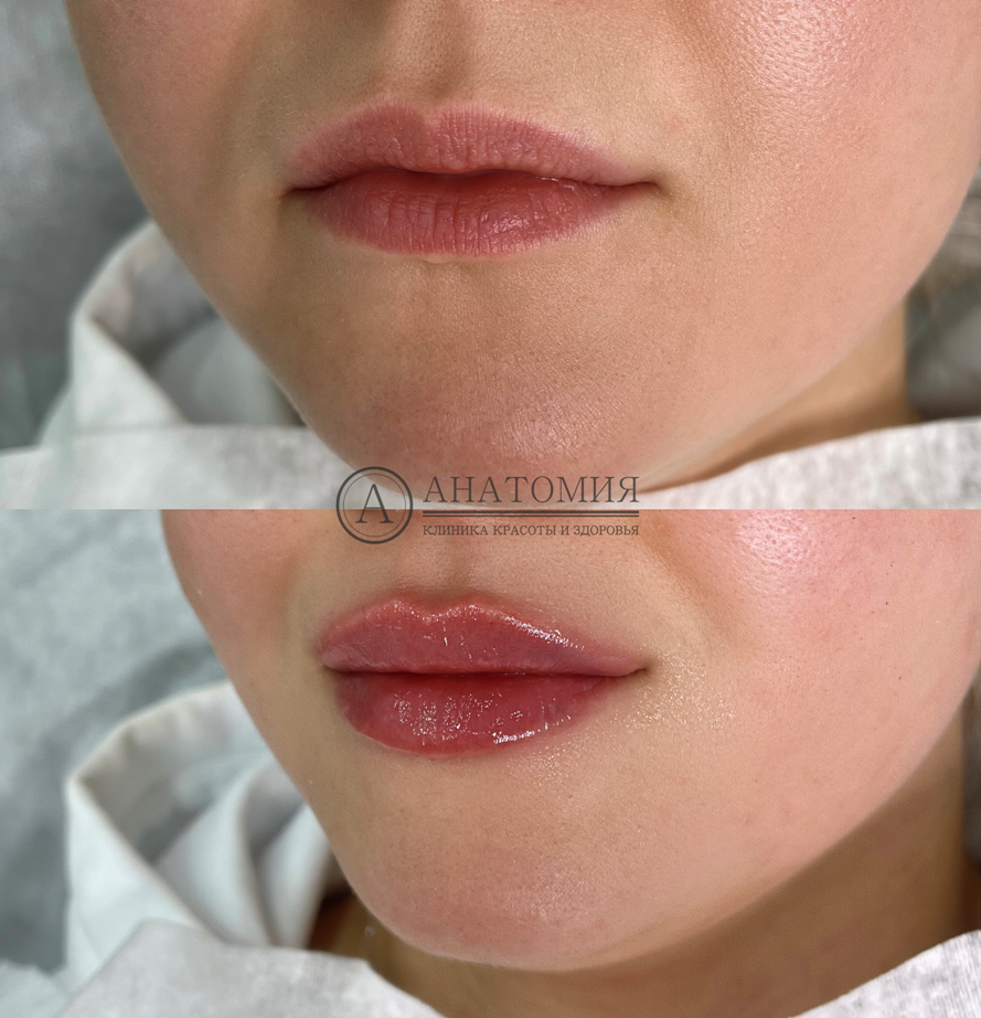 Примеры до и после контурной пластики губ (аугментация губ) | Сеть клиник Анатомия